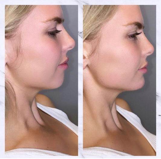 Chin Filler