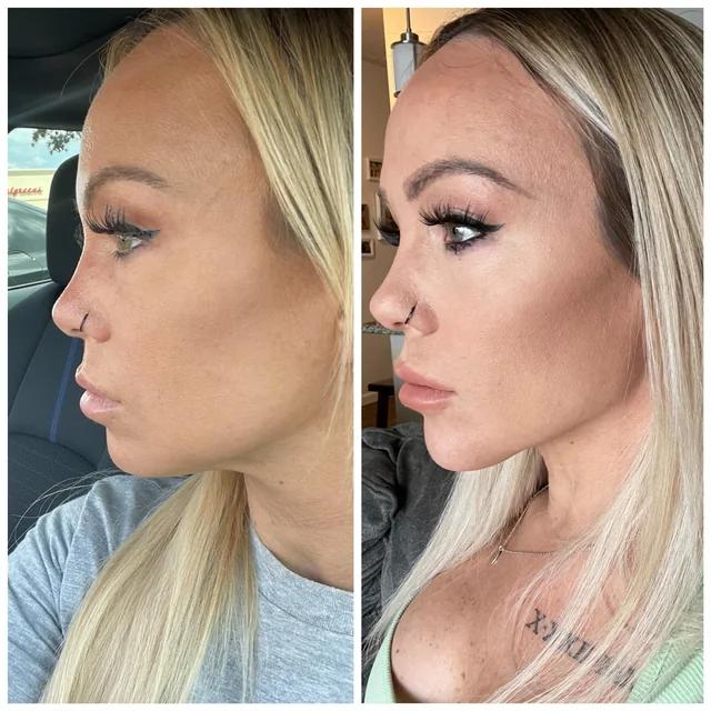 Jaw filler